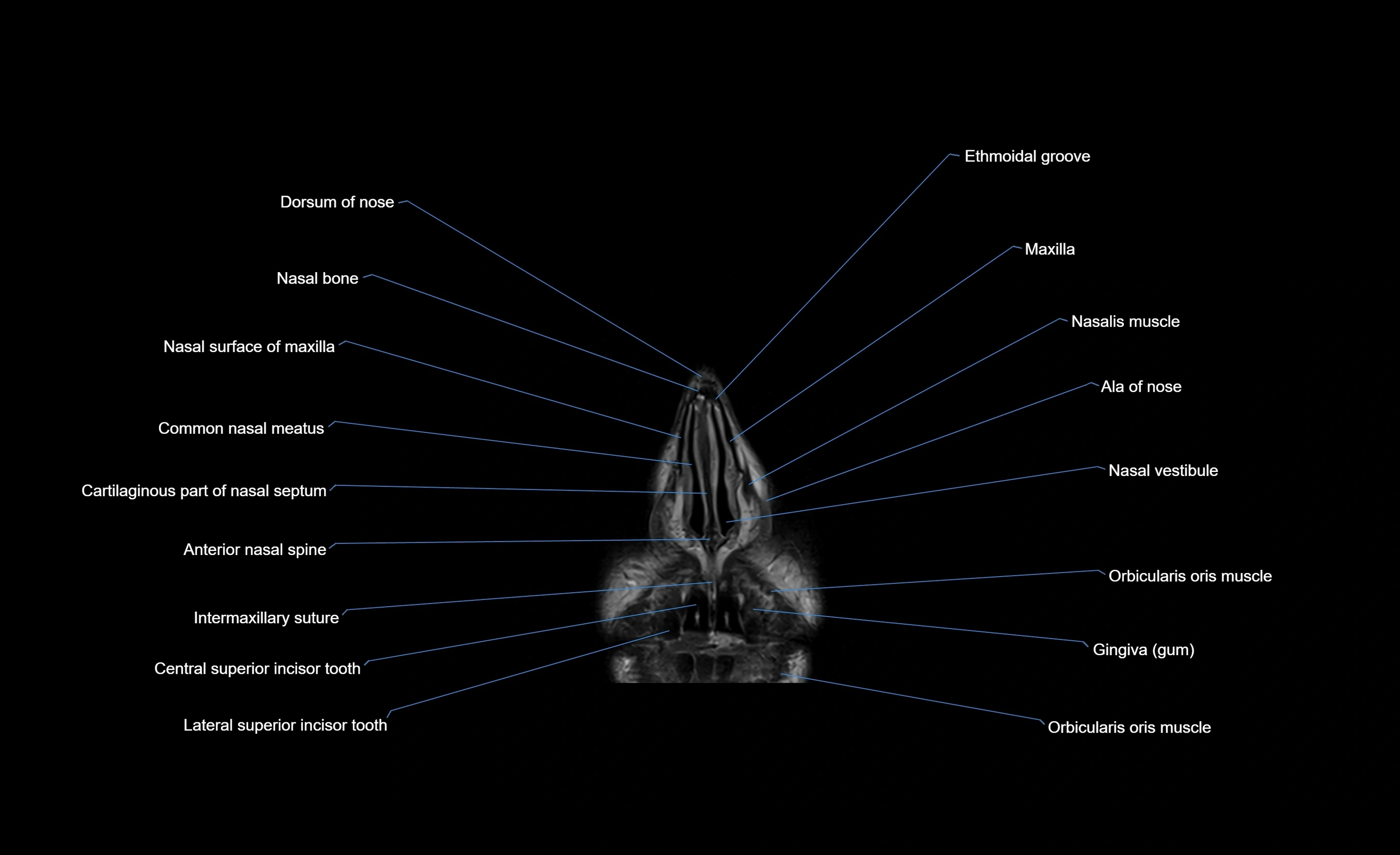 MRI face & paranasal sinuses(PNS) labelled  coronal  cross sectional anatomy 3T radiology  image-img-00001-00009.webp